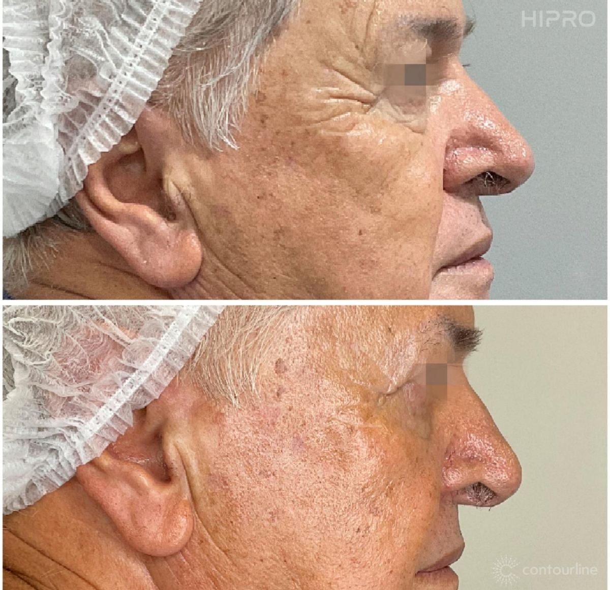 Antes e depois com HIPRO: terço médio e periocular, perfil