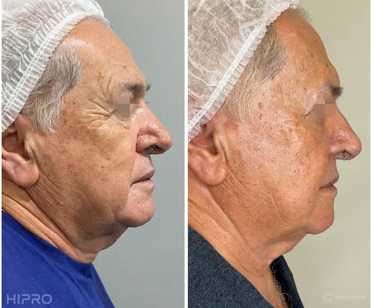 Antes e depois com HIPRO: papada e pescoço, perfil