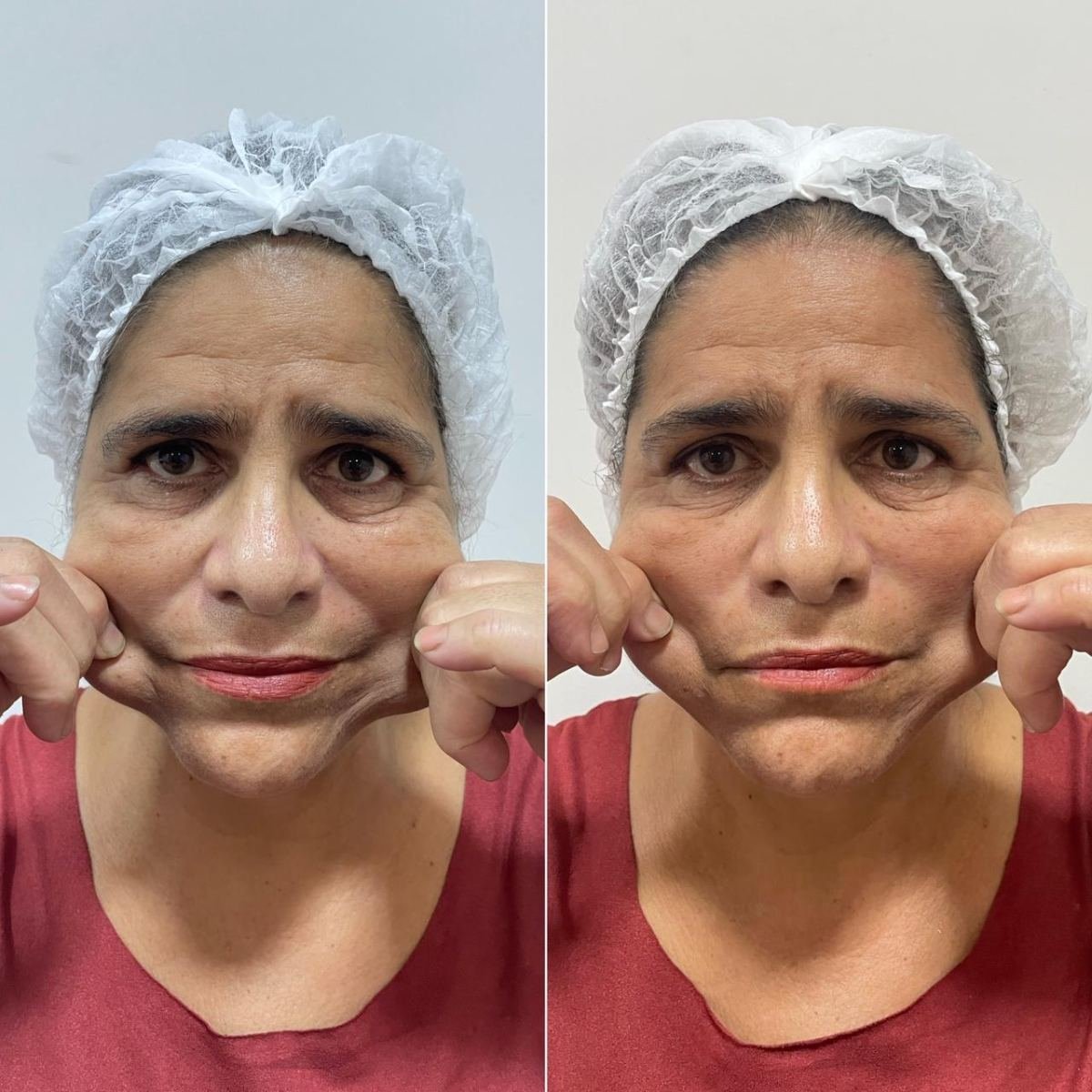 Antes e depois com HIPRO: terço médio, frontal
