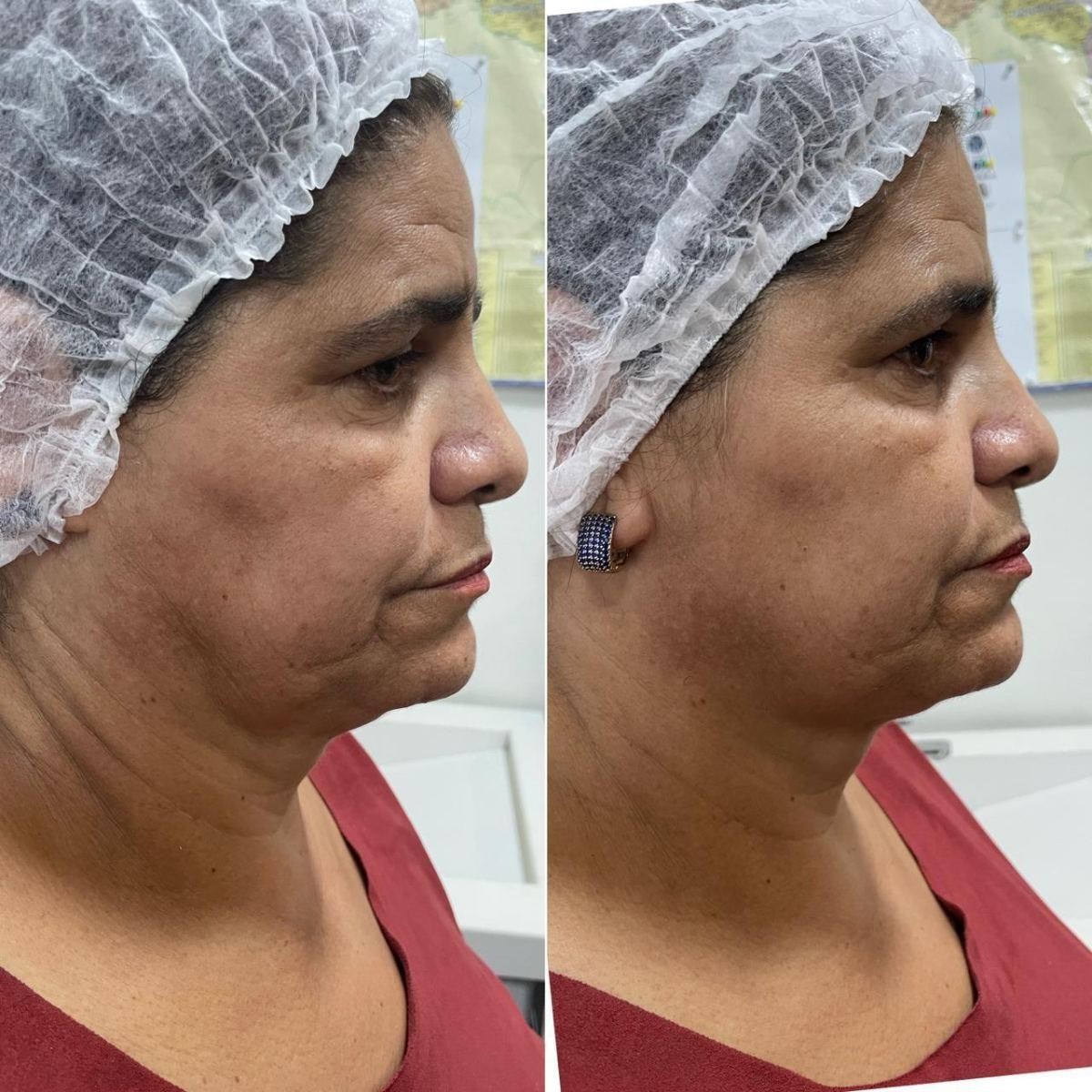 Antes e depois com HIPRO: papada e contorno mandibular, perfil