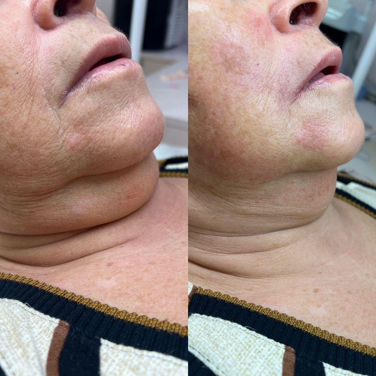 Antes e depois com HIPRO: papada, detalhe