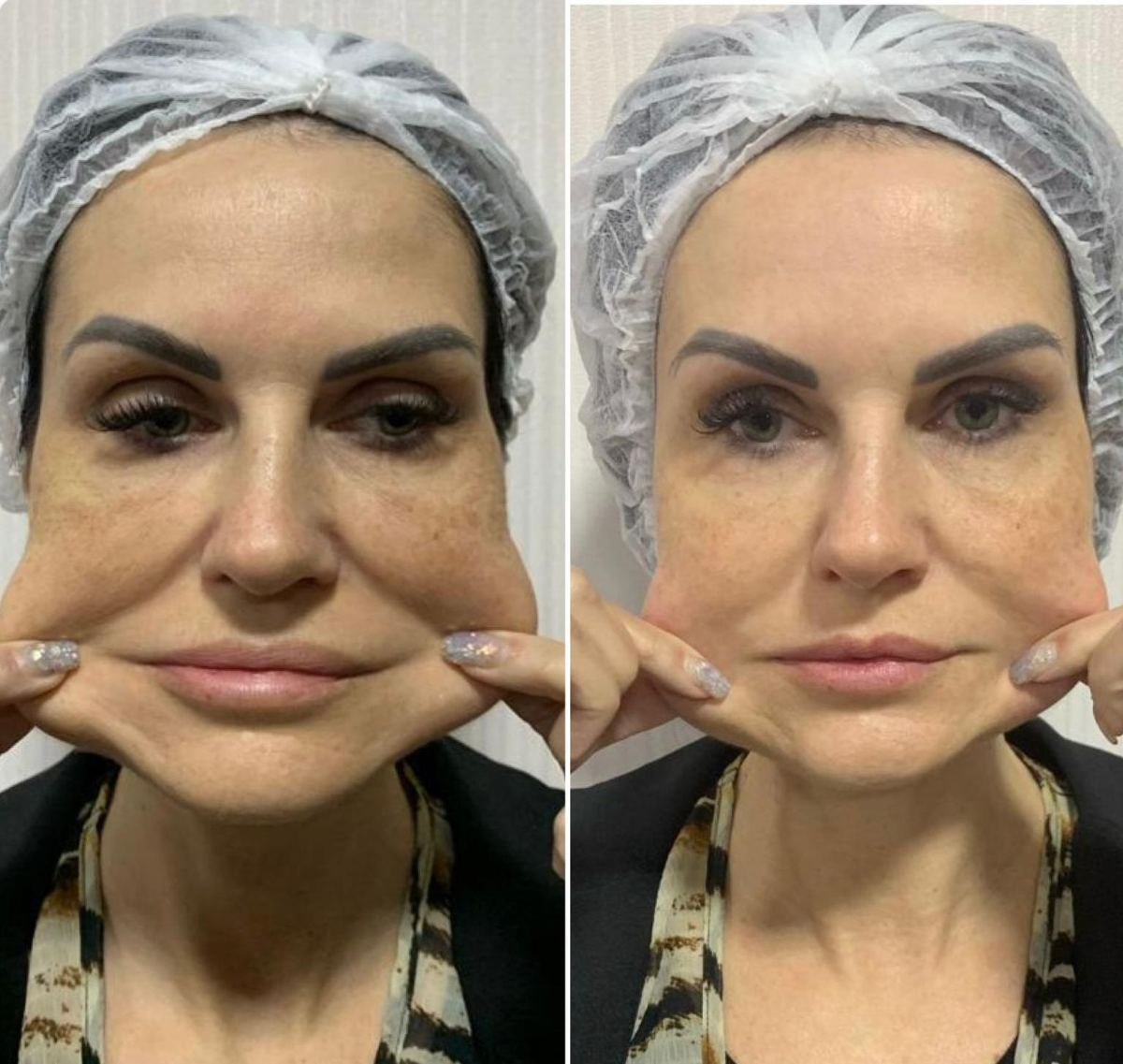 Antes e depois com HIPRO: terço médio, frontal
