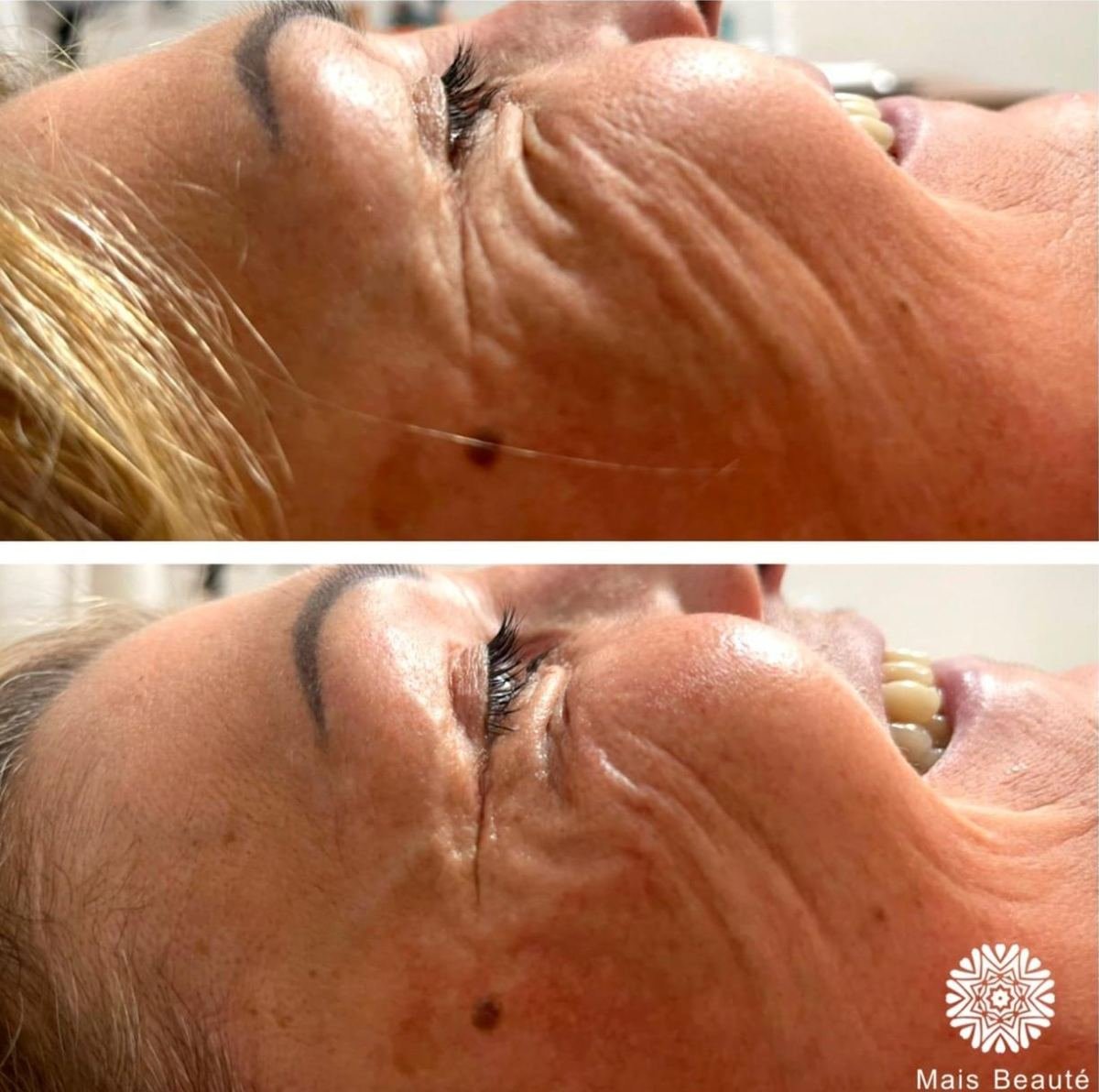 Antes e depois com HIPRO: periocular, detalhe