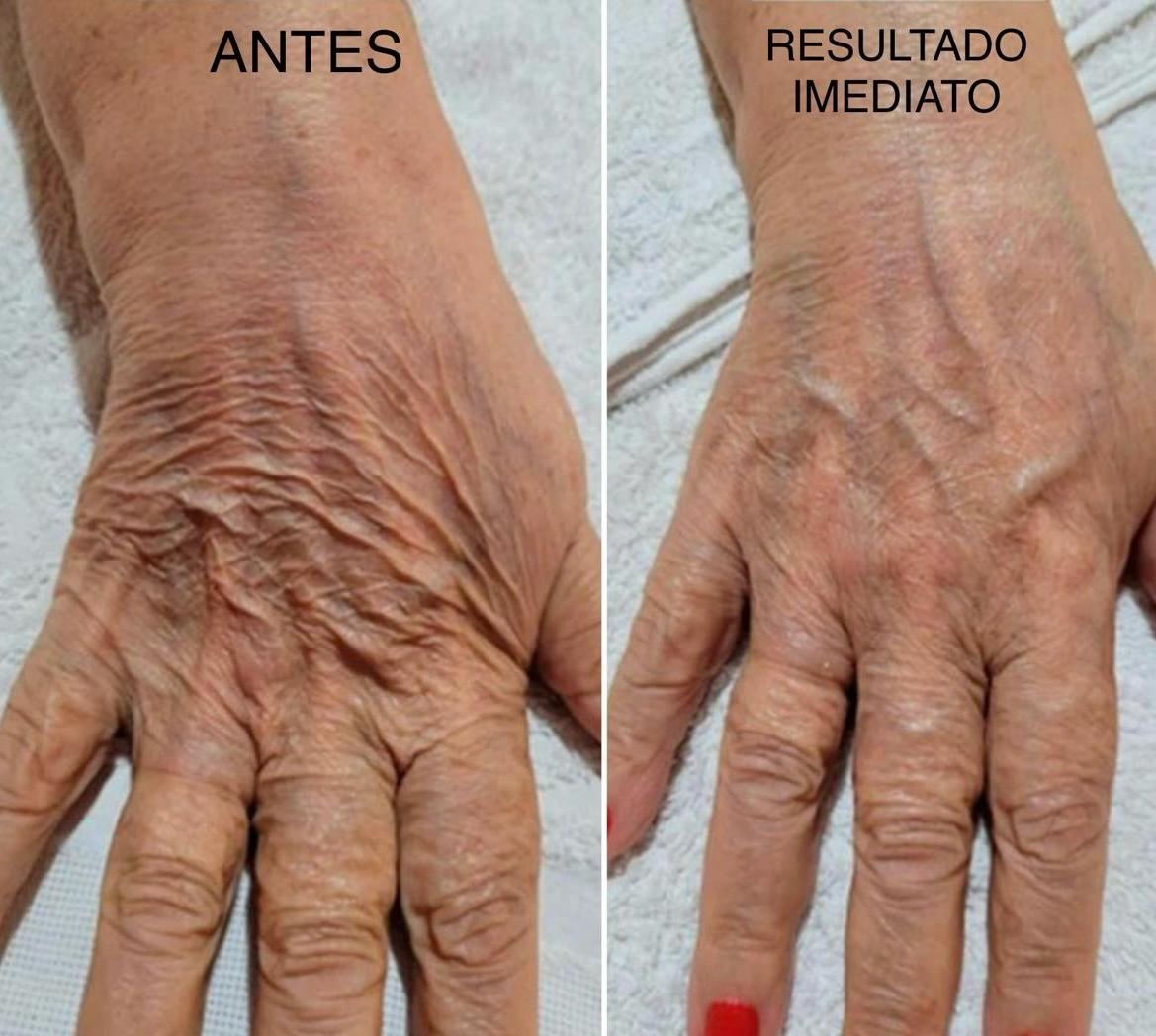 Antes e depois com HIPRO: mãos