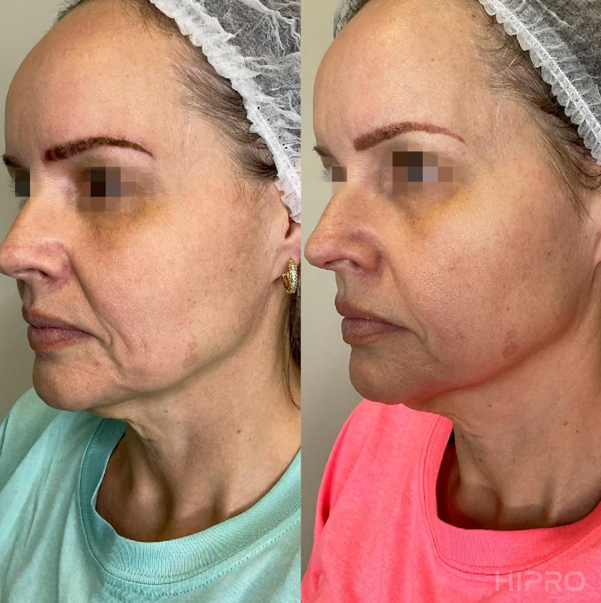 Antes e depois com HIPRO: terço médio e mandíbula, 3/4