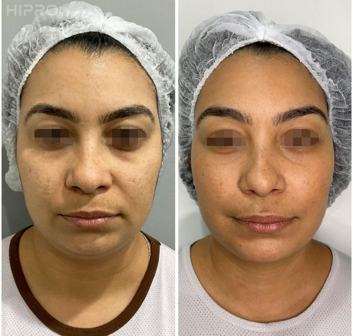 Antes e depois com HIPRO: terço médio, frontal