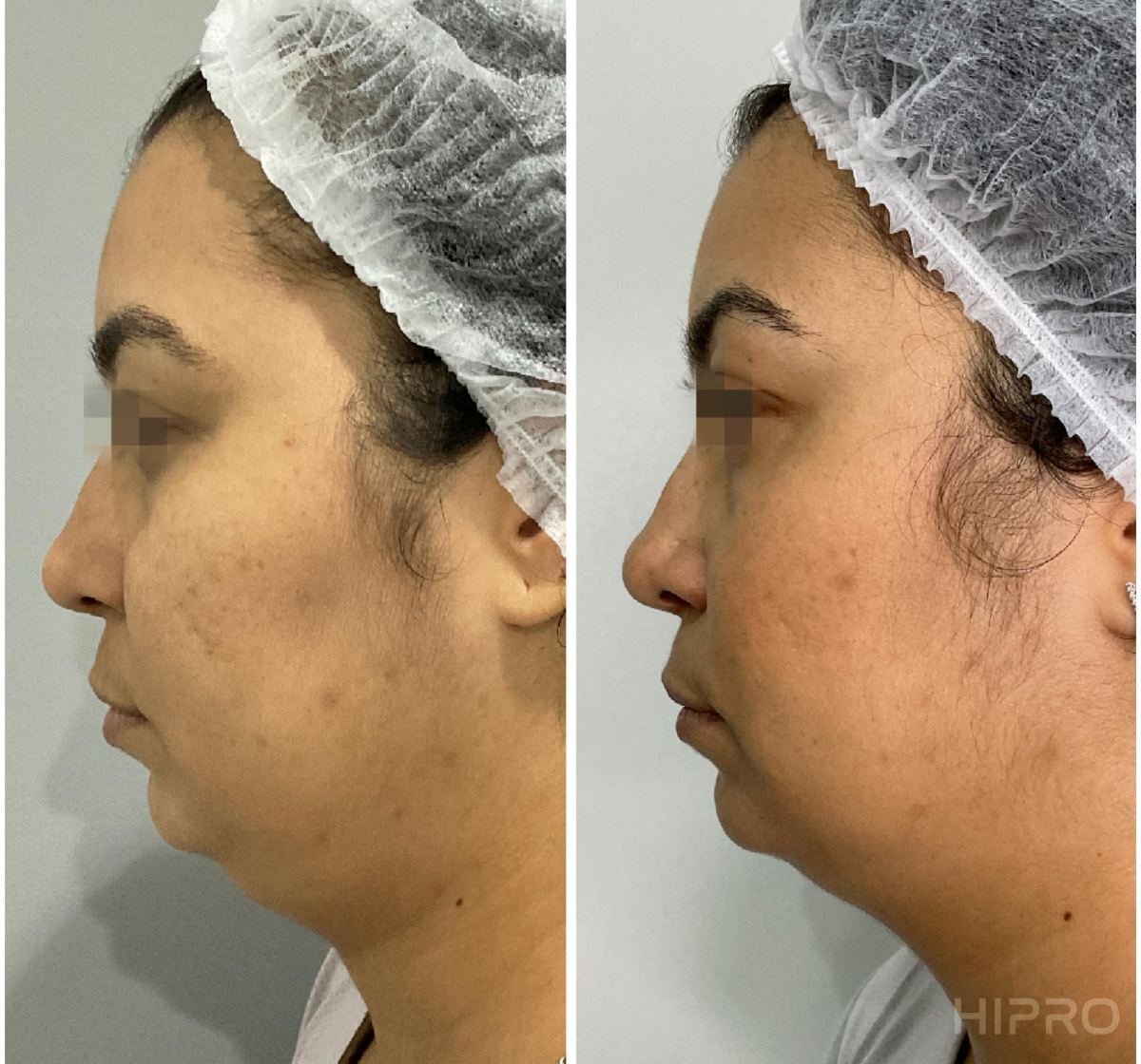 Antes e depois com HIPRO: papada e pescoço, perfil