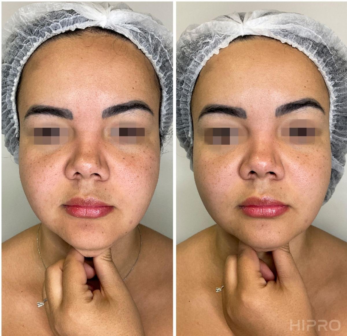 Antes e depois com HIPRO: papada e contorno mandibular, frontal