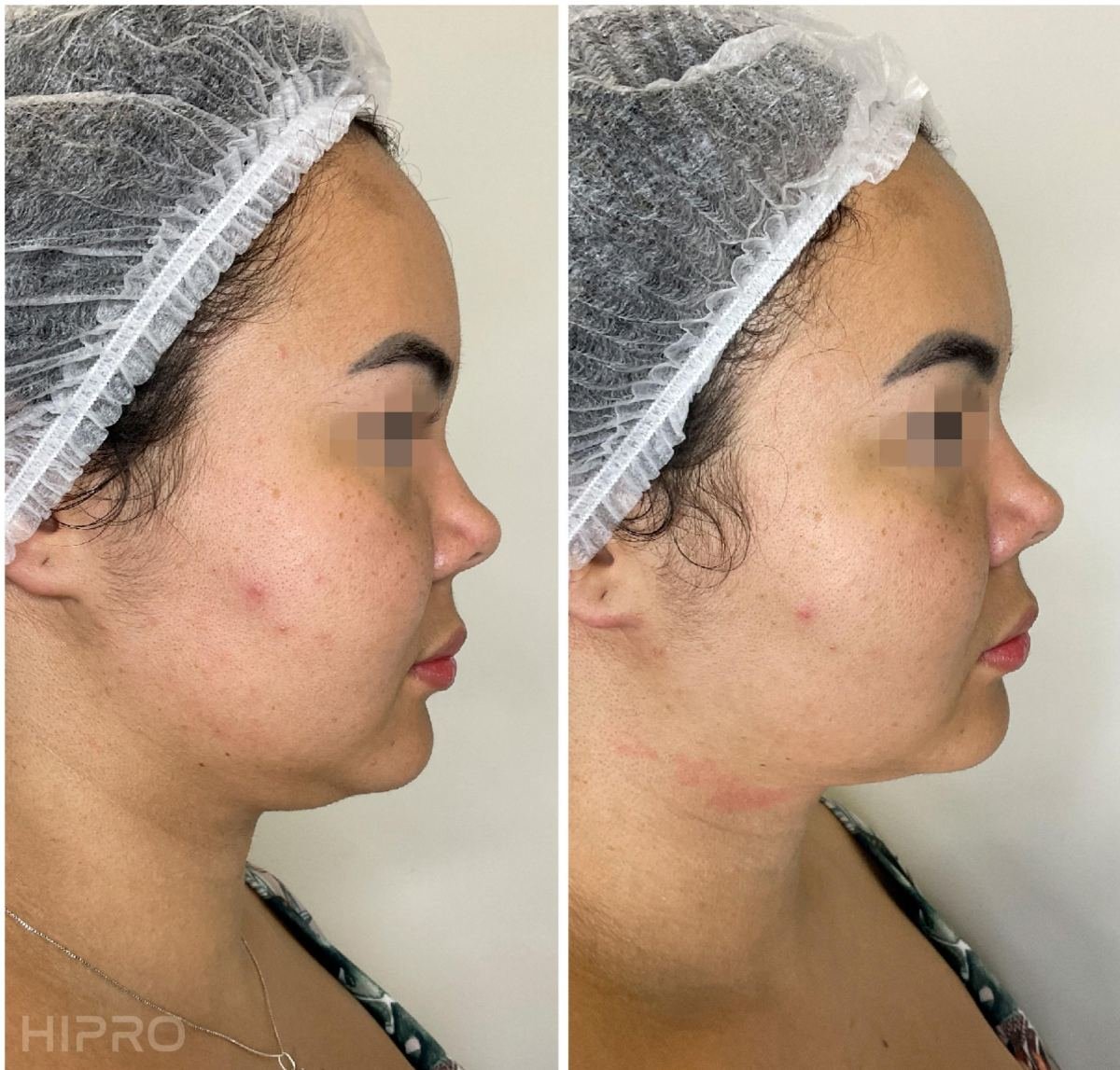 Antes e depois com HIPRO: papada e mandíbula, perfil