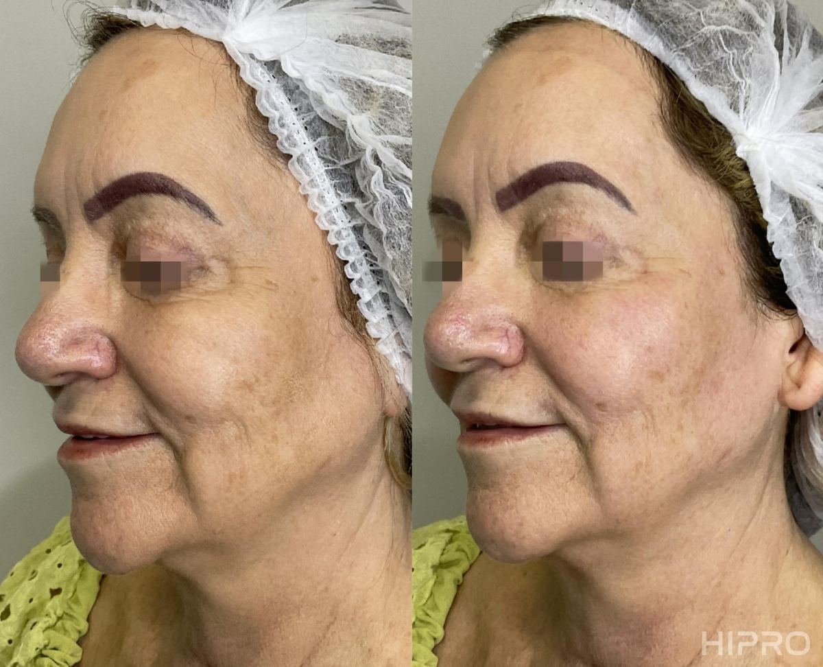 Antes e depois com HIPRO: terço médio e jowl, 3/4