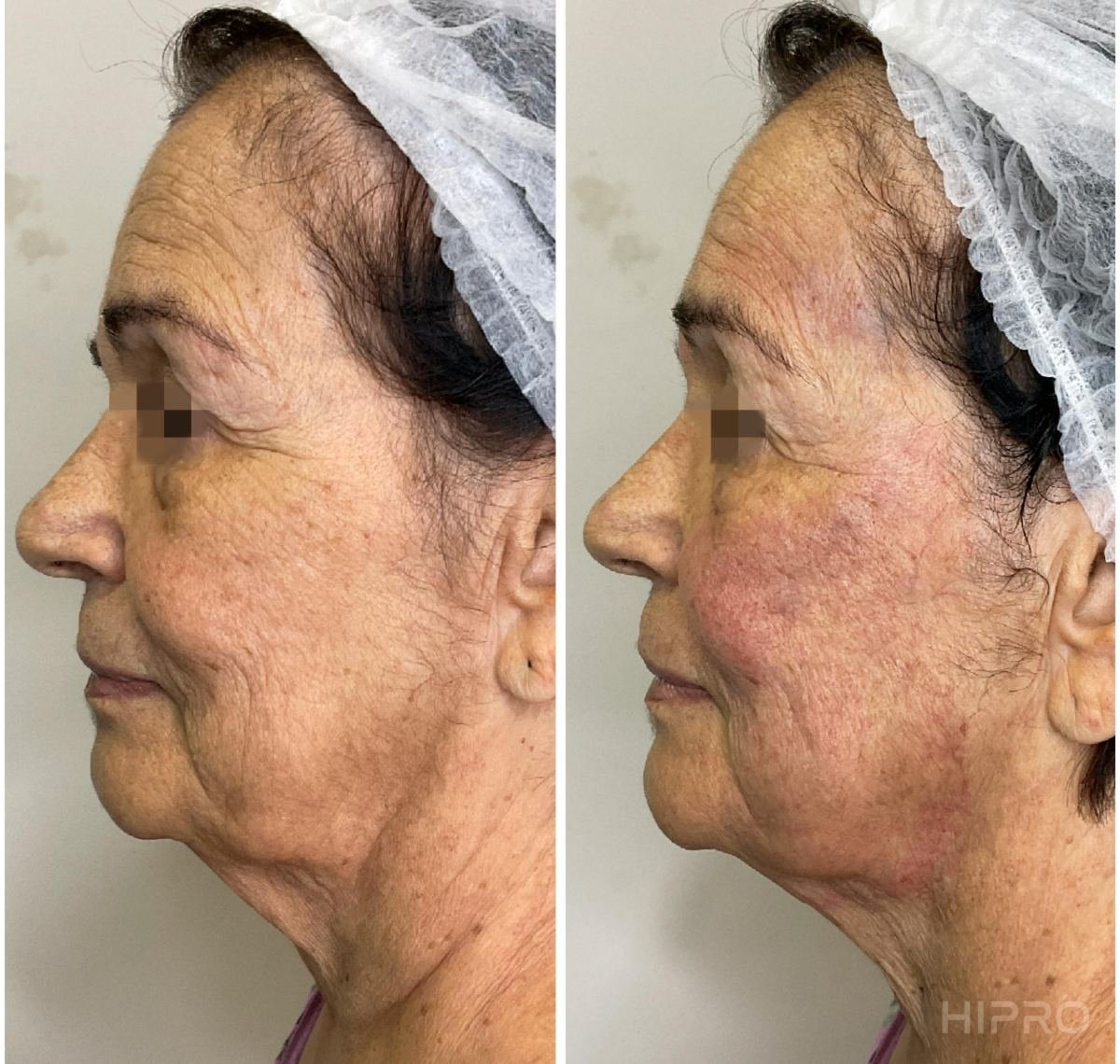 Antes e depois com HIPRO: terço médio e pescoço, perfil