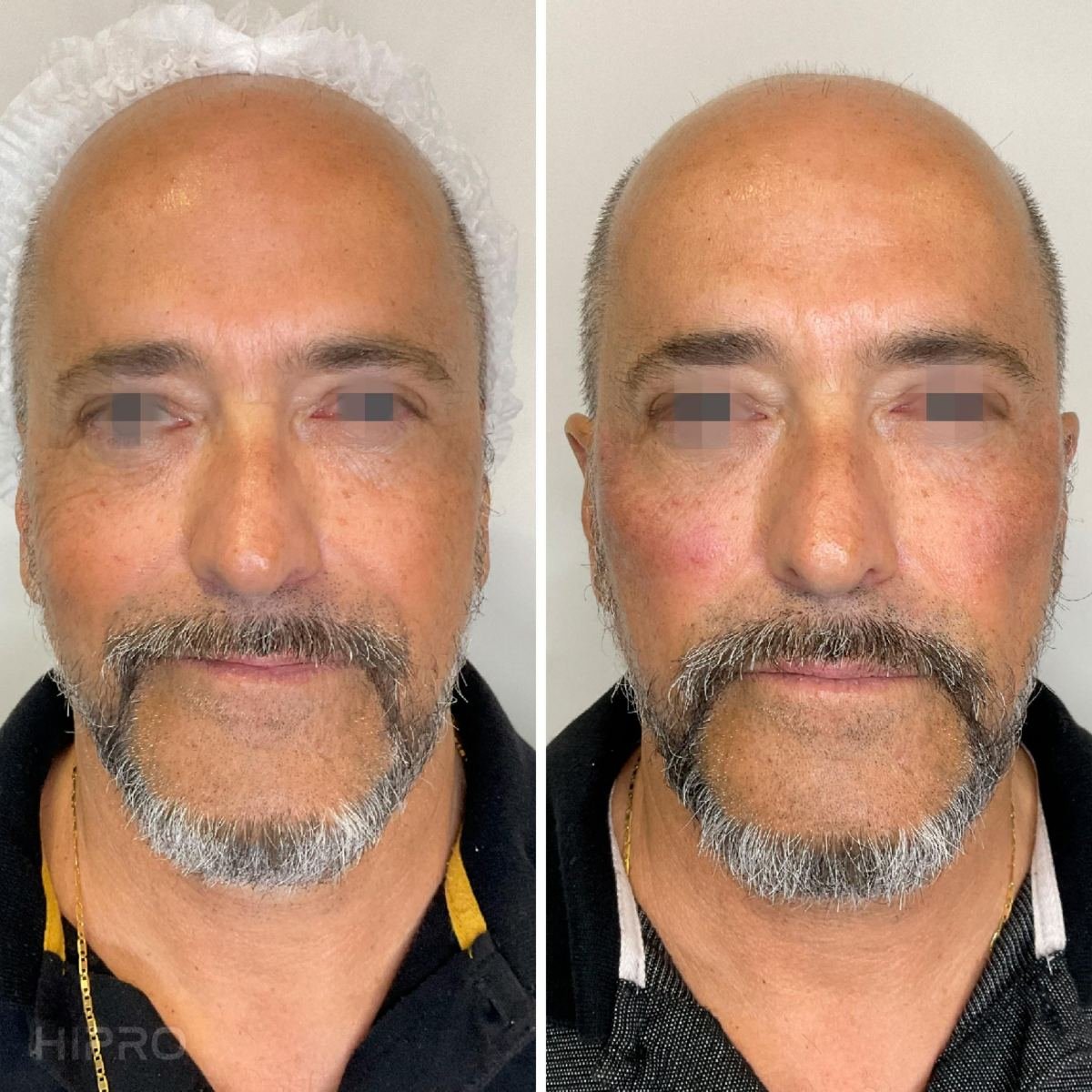 Antes e depois com HIPRO: terço médio, frontal