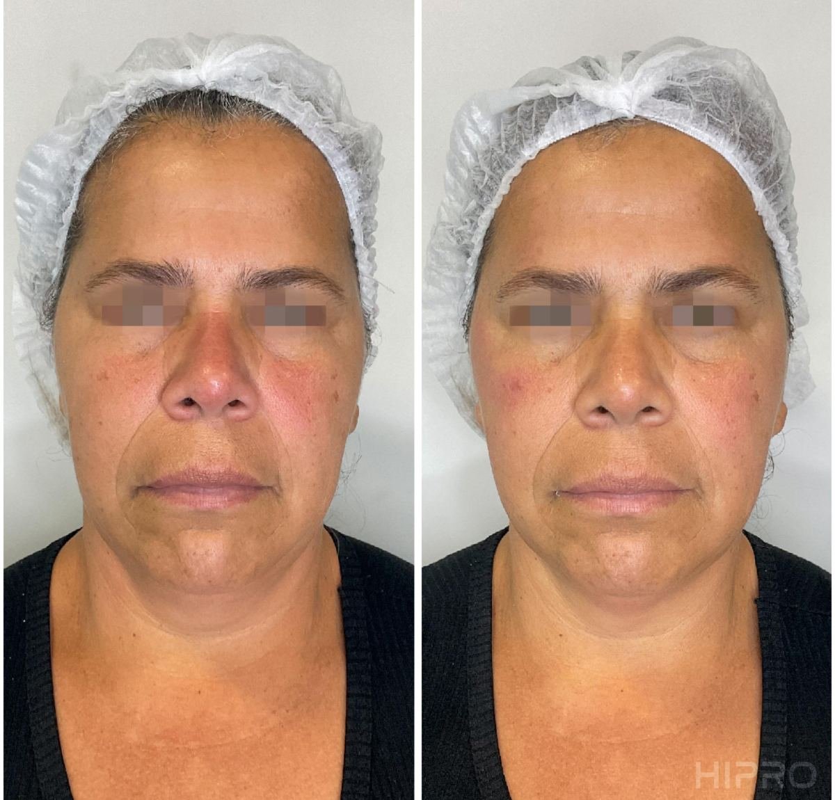 Antes e depois com HIPRO: terço médio e contorno, frontal