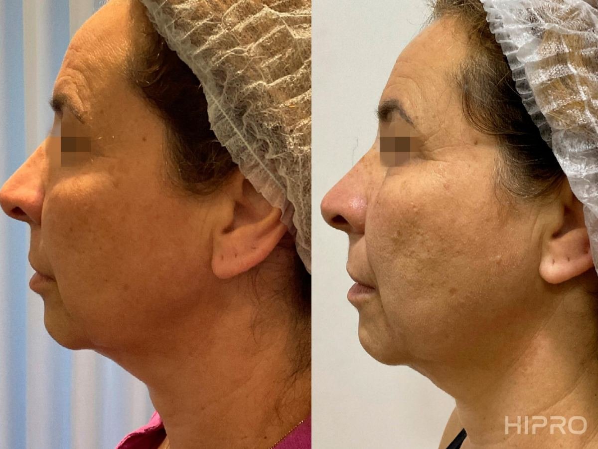 Antes e depois com HIPRO: papada, perfil
