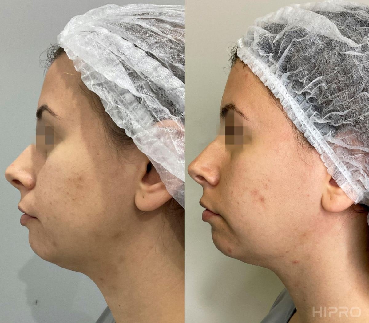 Antes e depois com HIPRO: mandíbula e papada, perfil