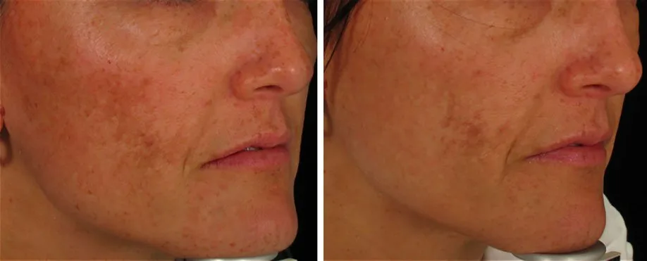 Fotoenvelhecimento antes e depois de luz intensa pulsada combinada com laser fracionado 1.927 nm