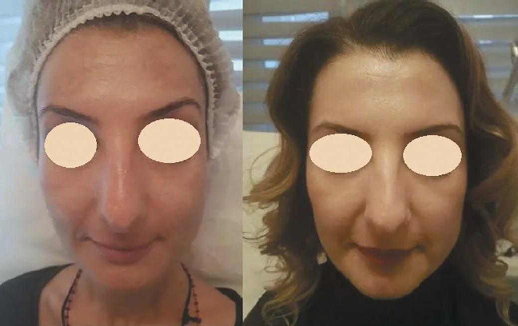 Melasma antes e seis meses depois do tratamento com laser de túlio 1.927 nm fracionado