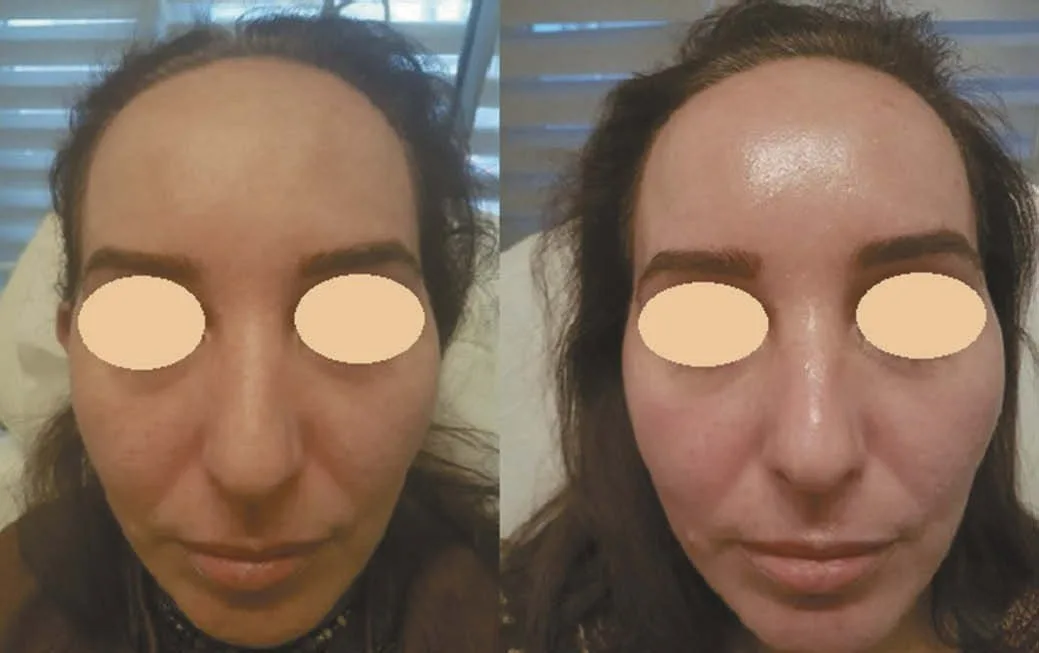 Melasma antes e depois do tratamento com laser de túlio 1.927 nm fracionado